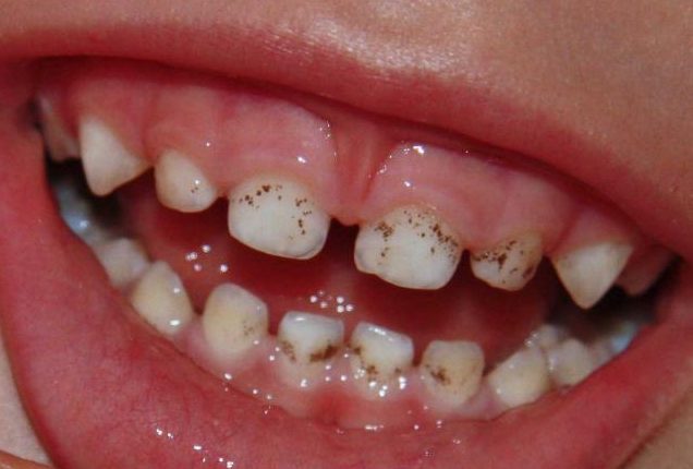 черные зубы у детей