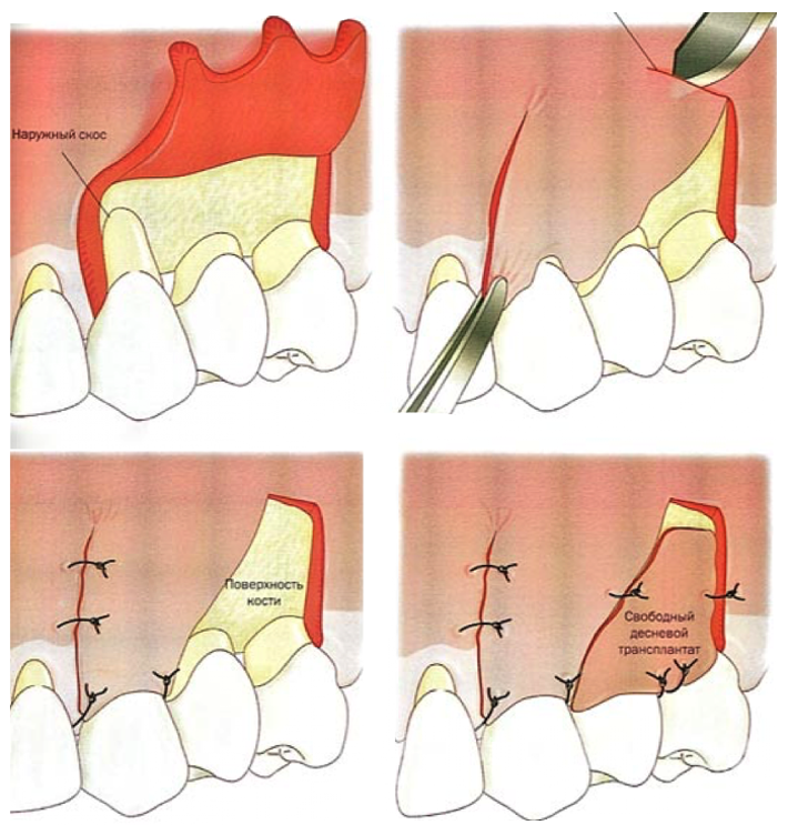 Лечение оголивших десны зубов thumbnail