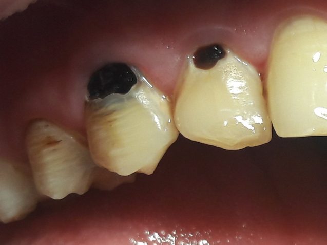 Десна в дырке зуба лечение thumbnail