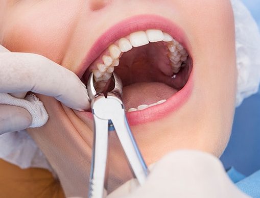 Чем полоскать рот после удаления зуба болит десна thumbnail