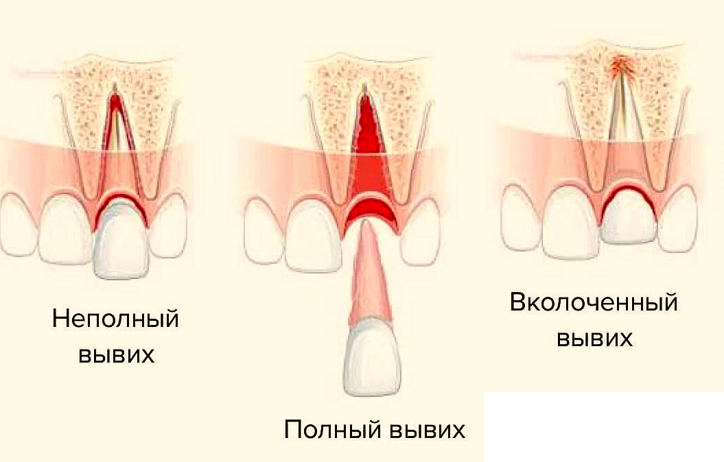 виды вывихов зубов