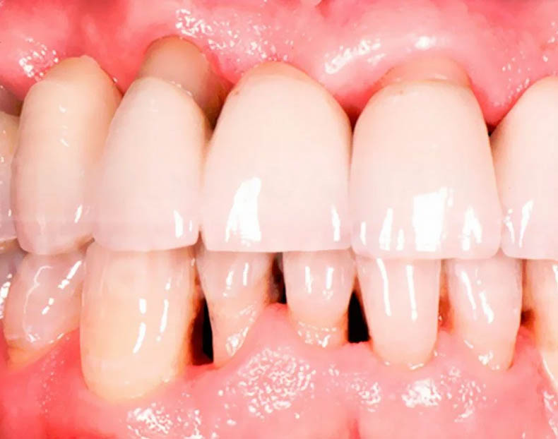 Антибиотик при воспалении десен и зубов после лечения thumbnail