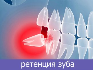 ретенция зуба
