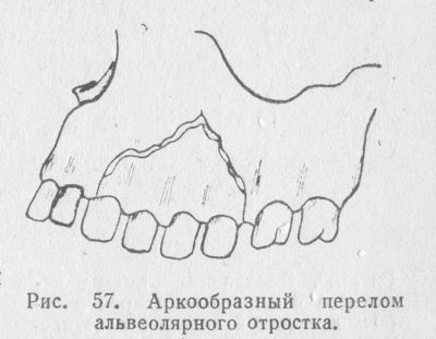 Переломы альвеолярных отростков нижней челюсти thumbnail