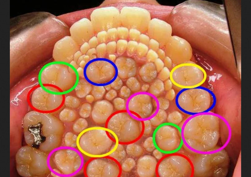Аномалии развития зубов фото
