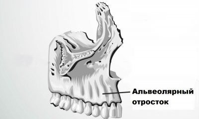 Перелом альвеолы зуба thumbnail
