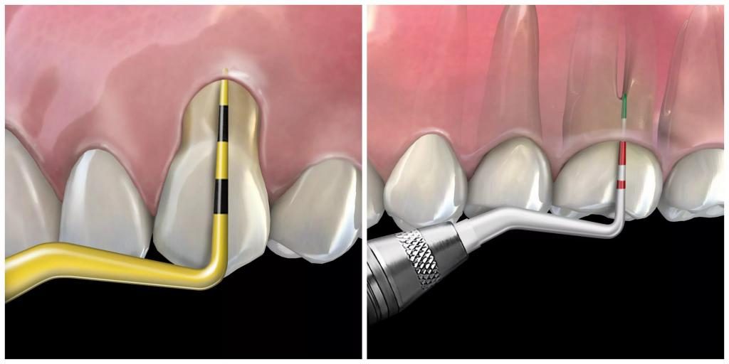Уменьшение глубины пародонтальных карманов