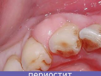 флюс у ребенка - периостит