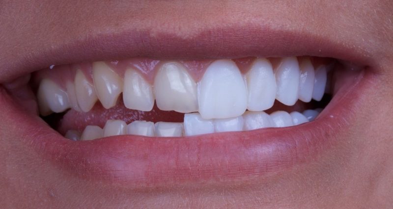 Почему во сне скрипят зубами взрослые люди лечение thumbnail