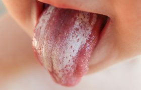 Кандидоз полости рта у детей