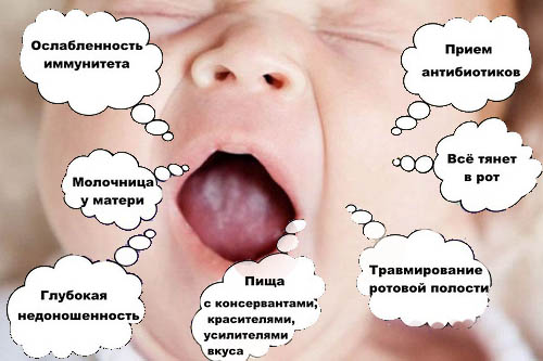 Кандидоз слизистой полости рта у детей лечение thumbnail