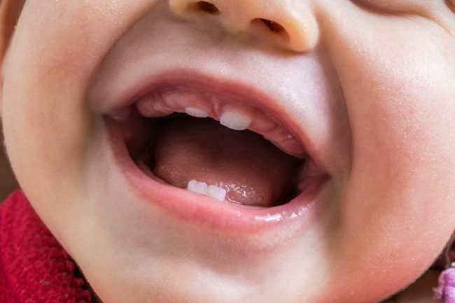 Обезболивание при прорезывании зубов