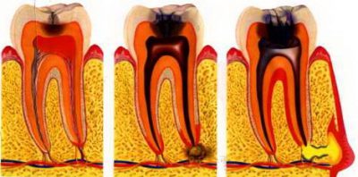 Некроз пульпы