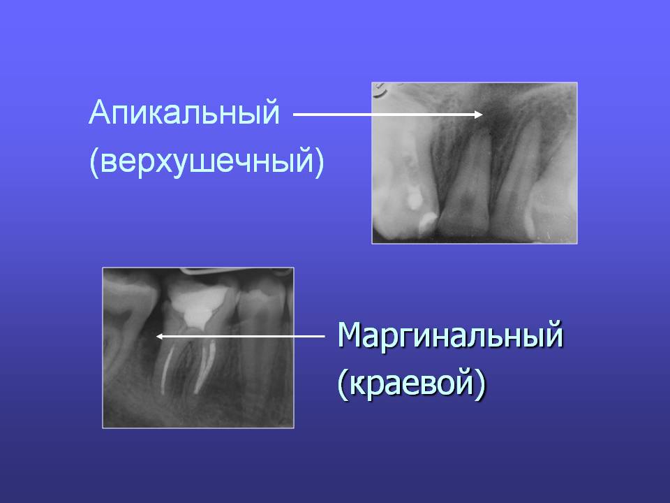 Маргинальный периодонтит фото